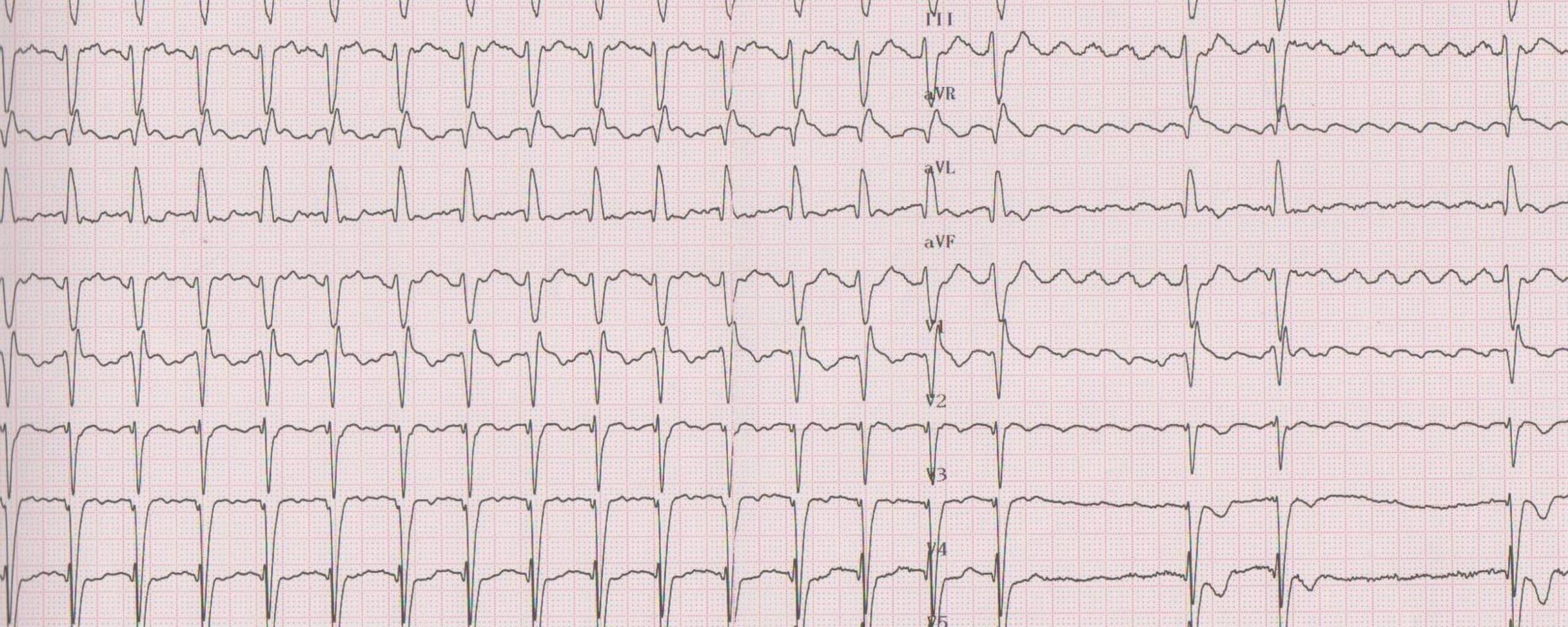 tachycardie met smalle QRS complexen